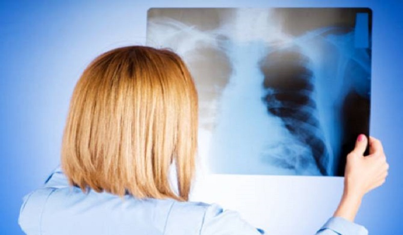 Ինչպես կանխել թոքերի օբստրուկտիվ հիվանդության զարգացումը